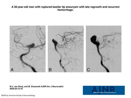 A 38-year-old man with ruptured basilar tip aneurysm with late regrowth and recurrent hemorrhage. A 38-year-old man with ruptured basilar tip aneurysm.