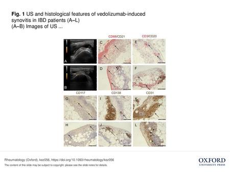 (A–B) Images of US ... (A–B) Images of US assessment of both patients who developed peripheral arthritis during vedolizumab treatment undergoing US-guided.