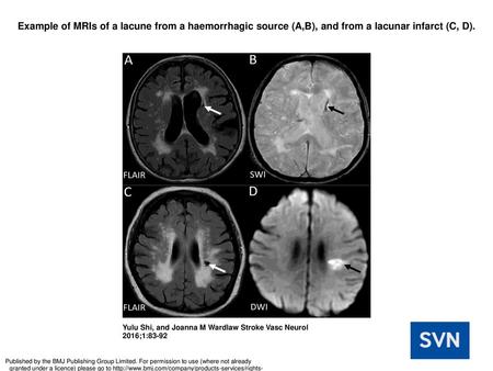 Example of MRIs of a lacune from a haemorrhagic source (A,B), and from a lacunar infarct (C, D). Example of MRIs of a lacune from a haemorrhagic source.
