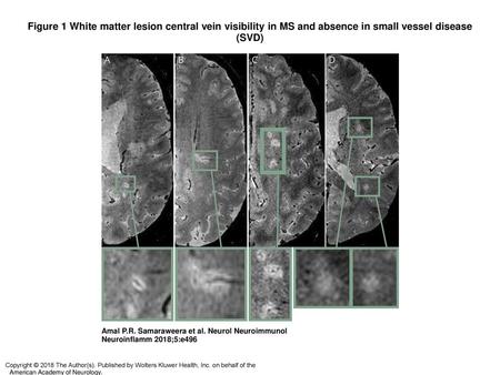 Figure 1 White matter lesion central vein visibility in MS and absence in small vessel disease (SVD)‏ White matter lesion central vein visibility in MS.
