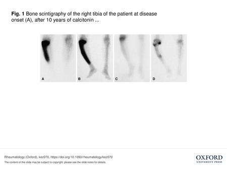 Fig. 1 Bone scintigraphy of the right tibia of the patient at disease onset (A), after 10 years of calcitonin ... Fig. 1 Bone scintigraphy of the right.