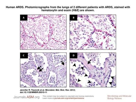 Human ARDS. Photomicrographs from the lungs of 2 different patients with ARDS, stained with hematoxylin and eosin (H&E) are shown. Human ARDS. Photomicrographs.