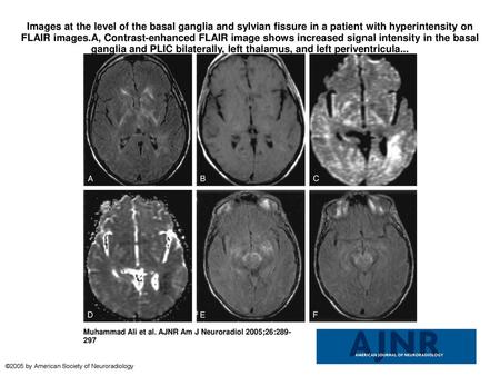 Images at the level of the basal ganglia and sylvian fissure in a patient with hyperintensity on FLAIR images.A, Contrast-enhanced FLAIR image shows increased.