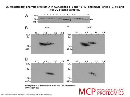 A, Western blot analysis of fetuin-A in AGA (lanes 1–5 and 10–13) and IUGR (lanes 6–9, 14, and 15) UC plasma samples. A, Western blot analysis of fetuin-A.