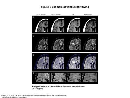 Figure 2 Example of venous narrowing