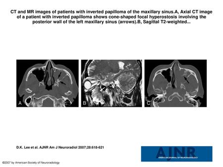 CT and MR images of patients with inverted papilloma of the maxillary sinus.A, Axial CT image of a patient with inverted papilloma shows cone-shaped focal.