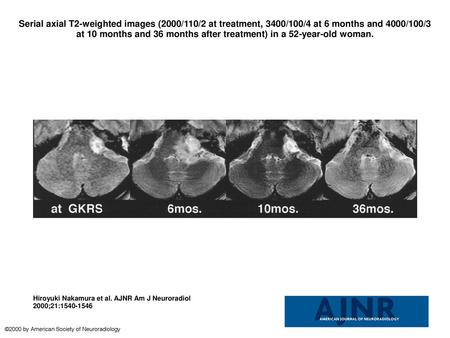 Serial axial T2-weighted images (2000/110/2 at treatment, 3400/100/4 at 6 months and 4000/100/3 at 10 months and 36 months after treatment) in a 52-year-old.