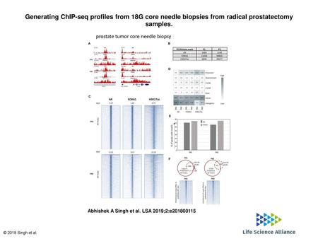 Generating ChIP-seq profiles from 18G core needle biopsies from radical prostatectomy samples. Generating ChIP-seq profiles from 18G core needle biopsies.
