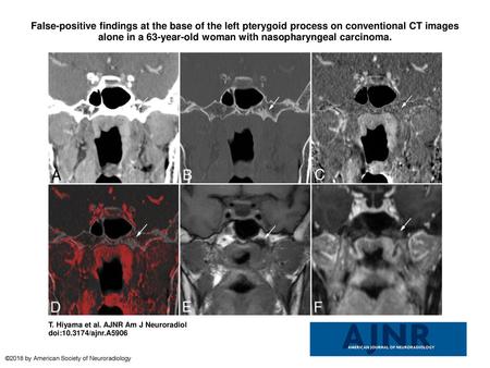 False-positive findings at the base of the left pterygoid process on conventional CT images alone in a 63-year-old woman with nasopharyngeal carcinoma.