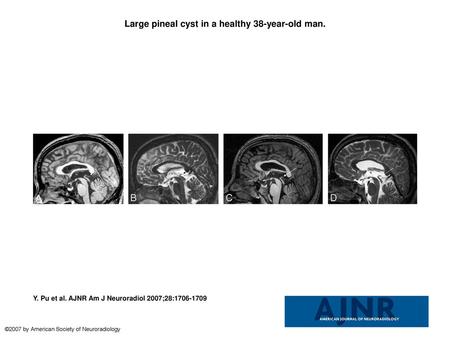 Large pineal cyst in a healthy 38-year-old man.