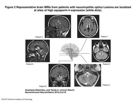 Figure 2 Representative brain MRIs from patients with neuromyelitis optica Lesions are localized at sites of high aquaporin-4 expression (white dots).