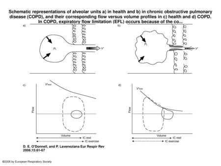 Schematic representations of alveolar units a) in health and b) in chronic obstructive pulmonary disease (COPD), and their corresponding flow versus volume.