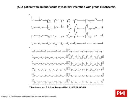 (A) A patient with anterior acute myocardial infarction with grade II ischaemia. (A) A patient with anterior acute myocardial infarction with grade II.