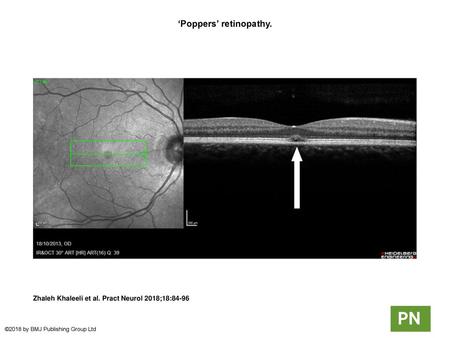 ‘Poppers’ retinopathy.
