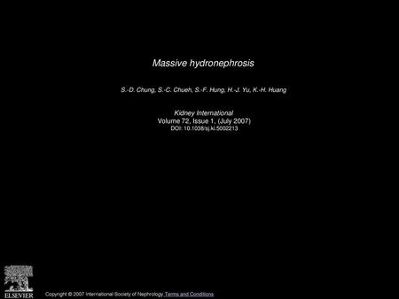 Massive hydronephrosis