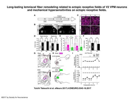 Long-lasting lemniscal fiber remodeling related to ectopic receptive fields of V2 VPM neurons and mechanical hypersensitivities on ectopic receptive fields.