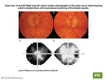 Case one: (A and B) Right and left colour fundus photographs of the optic nerve head showing small crowded discs with anomalous branching of the blood.