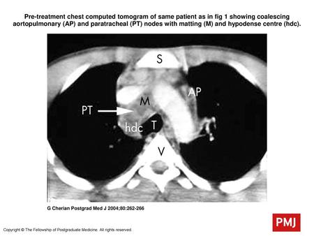 Pre-treatment chest computed tomogram of same patient as in fig 1 showing coalescing aortopulmonary (AP) and paratracheal (PT) nodes with matting (M) and.