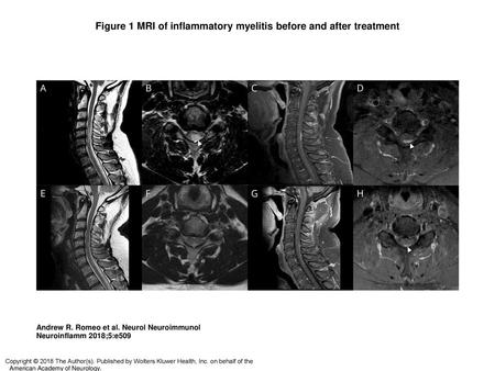 Figure 1 MRI of inflammatory myelitis before and after treatment