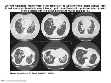 Different radiological “phenotypes” of bronchiectasis
