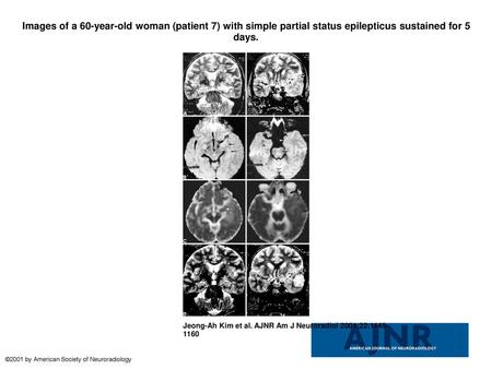 Images of a 60-year-old woman (patient 7) with simple partial status epilepticus sustained for 5 days. Images of a 60-year-old woman (patient 7) with simple.