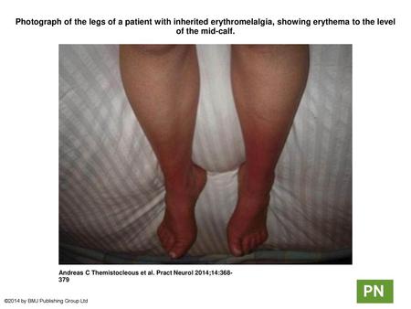 Photograph of the legs of a patient with inherited erythromelalgia, showing erythema to the level of the mid-calf. Photograph of the legs of a patient.