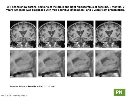 MRI scans show coronal sections of the brain and right hippocampus at baseline, 9 months, 2 years (when he was diagnosed with mild cognitive impairment)