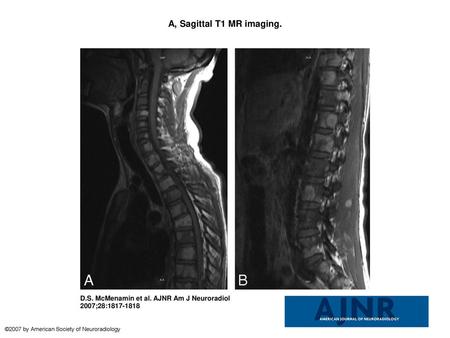 A, Sagittal T1 MR imaging. A, Sagittal T1 MR imaging. Multiple bone lesions with T1 hyperintensity involve the cervical and thoracic spine, with a pathologic.