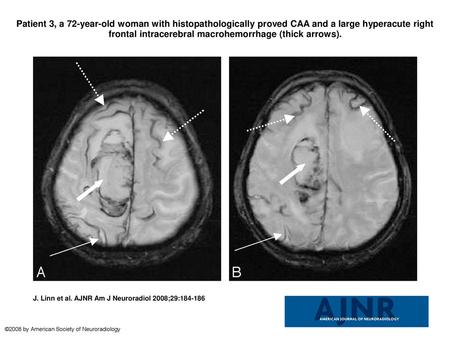 Patient 3, a 72-year-old woman with histopathologically proved CAA and a large hyperacute right frontal intracerebral macrohemorrhage (thick arrows). Patient.