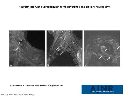 Neurotmesis with suprascapular nerve severance and axillary neuropathy