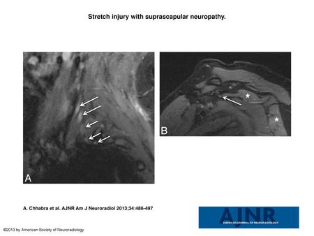 Stretch injury with suprascapular neuropathy.
