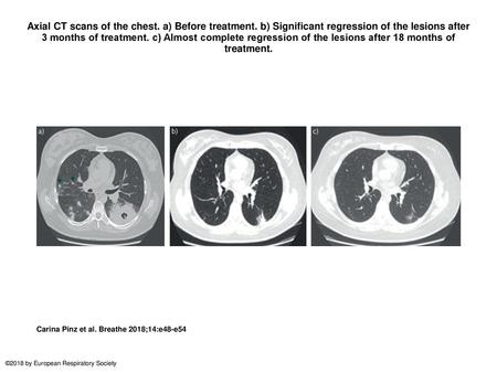Axial CT scans of the chest. a) Before treatment