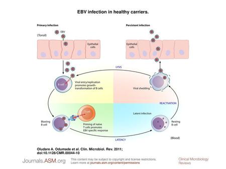 EBV infection in healthy carriers.