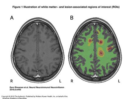 Figure 1 Illustration of white matter– and lesion-associated regions of interest (ROIs)‏ Illustration of white matter– and lesion-associated regions of.