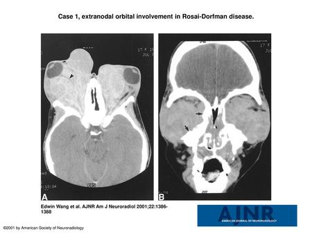 Case 1, extranodal orbital involvement in Rosai-Dorfman disease.