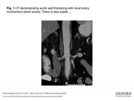 Fig. 1 CT demonstrating aortic wall thickening with renal artery involvement (short arrow). There is also subtle ... Fig. 1 CT demonstrating aortic wall.