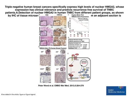 Triple‐negative human breast cancers specifically express high levels of nuclear HMGA2, whose expression has clinical relevance and predicts recurrence‐free.