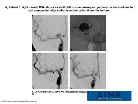 A, Patient 8: right carotid DSA shows a carotid bifurcation aneurysm, partially recanalized due to coil compaction after coil-only embolization 6 months.