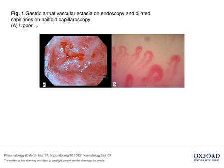 (A) Upper ... (A) Upper gastroduodenoscopy showing gastric antral vascular ectasia with visible bleeding. (B) Nailfold capillaroscopy showing dilated capillaries.