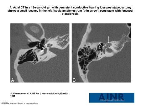 A, Axial CT in a 15-year-old girl with persistent conductive hearing loss poststapedectomy shows a small lucency in the left fissula antefenestrum (thin.
