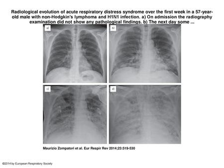 Radiological evolution of acute respiratory distress syndrome over the first week in a 57-year-old male with non-Hodgkin’s lymphoma and H1N1 infection.