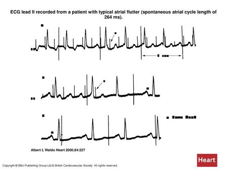 ECG lead II recorded from a patient with typical atrial flutter (spontaneous atrial cycle length of 264 ms). ECG lead II recorded from a patient with typical.