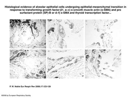 Histological evidence of alveolar epithelial cells undergoing epithelial-mesenchymal transition in response to transforming growth factor-β1. a–c) α-smooth.