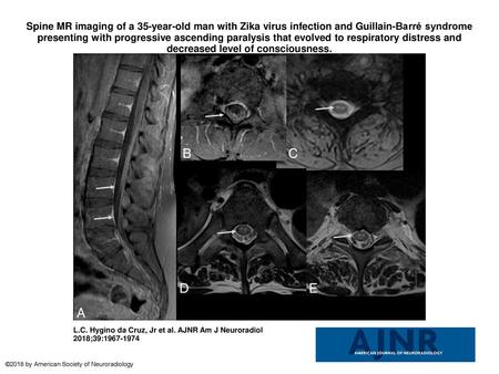 Spine MR imaging of a 35-year-old man with Zika virus infection and Guillain-Barré syndrome presenting with progressive ascending paralysis that evolved.