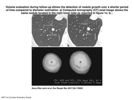 Volume evaluation during follow-up allows the detection of nodule growth over a shorter period of time compared to diameter estimation. a) Computed tomography.