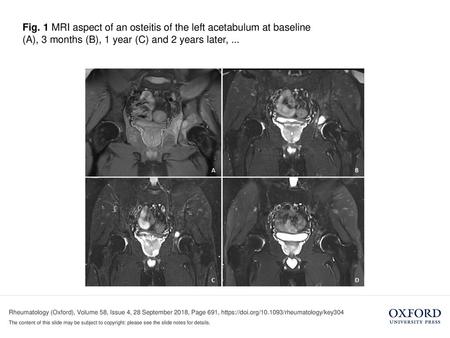 Fig. 1 MRI aspect of an osteitis of the left acetabulum at baseline (A), 3 months (B), 1 year (C) and 2 years later, ... Fig. 1 MRI aspect of an osteitis.