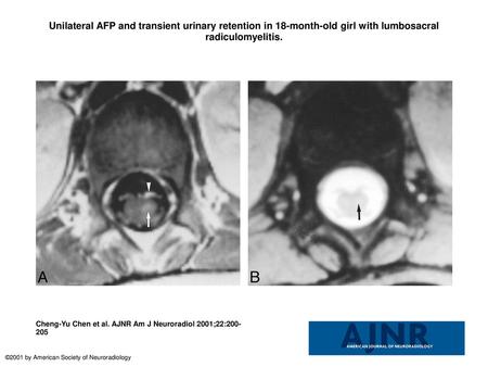 Unilateral AFP and transient urinary retention in 18-month-old girl with lumbosacral radiculomyelitis. Unilateral AFP and transient urinary retention in.