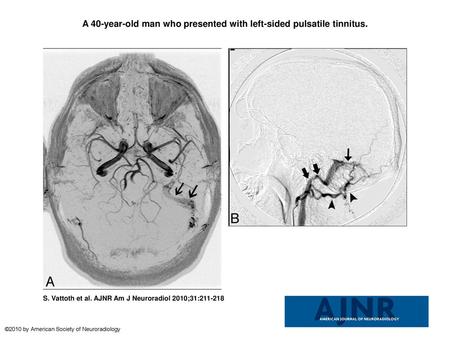 A 40-year-old man who presented with left-sided pulsatile tinnitus.