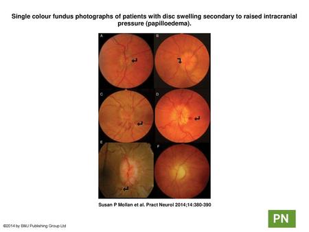 Single colour fundus photographs of patients with disc swelling secondary to raised intracranial pressure (papilloedema). Single colour fundus photographs.