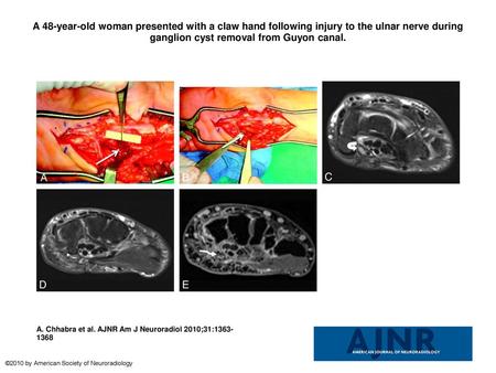 A 48-year-old woman presented with a claw hand following injury to the ulnar nerve during ganglion cyst removal from Guyon canal. A 48-year-old woman presented.